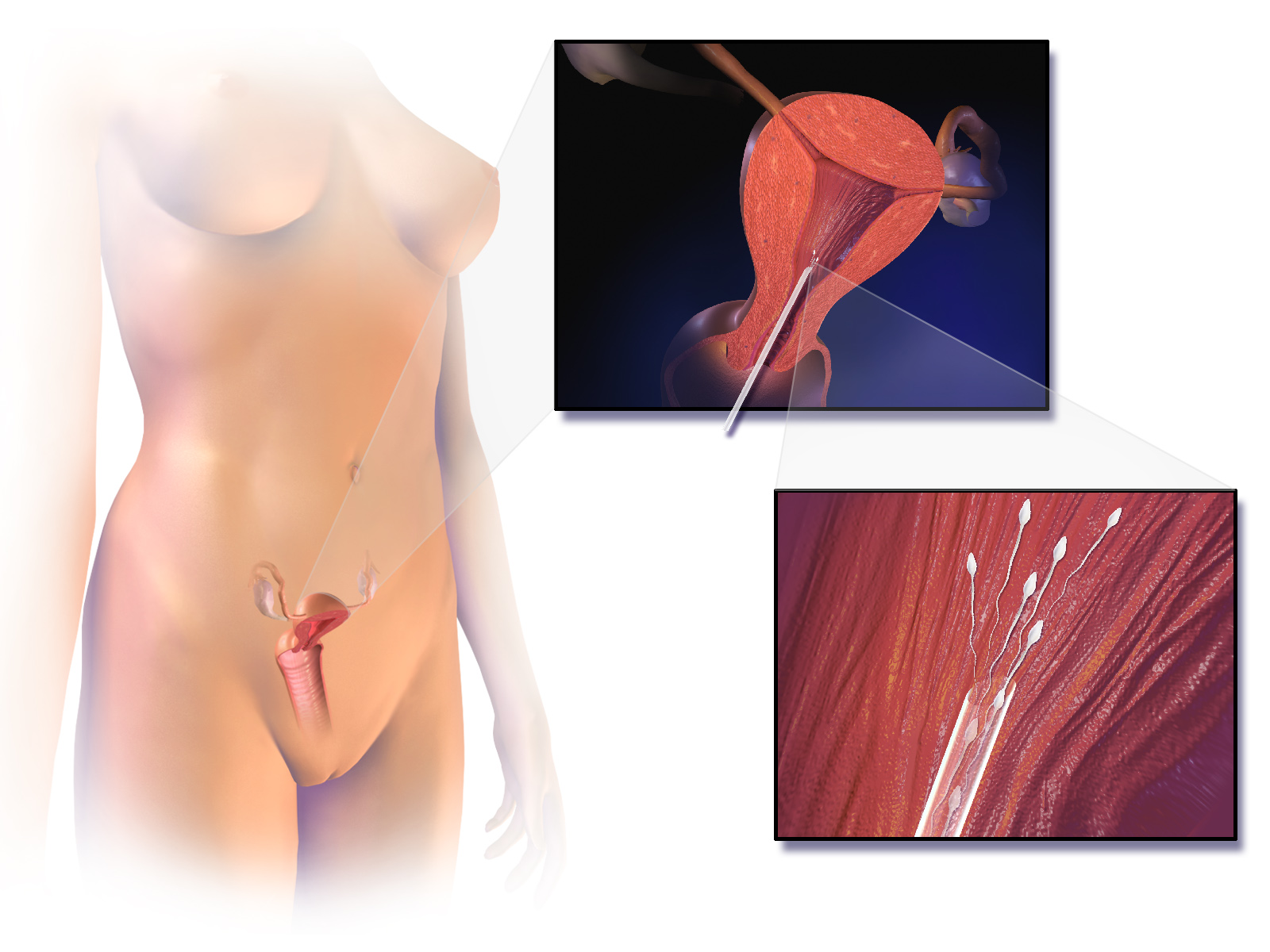Imagem de referência de inseminação artificial, descrito nos dados abertos como uso de métodos artificiais para facilitar a gravidez