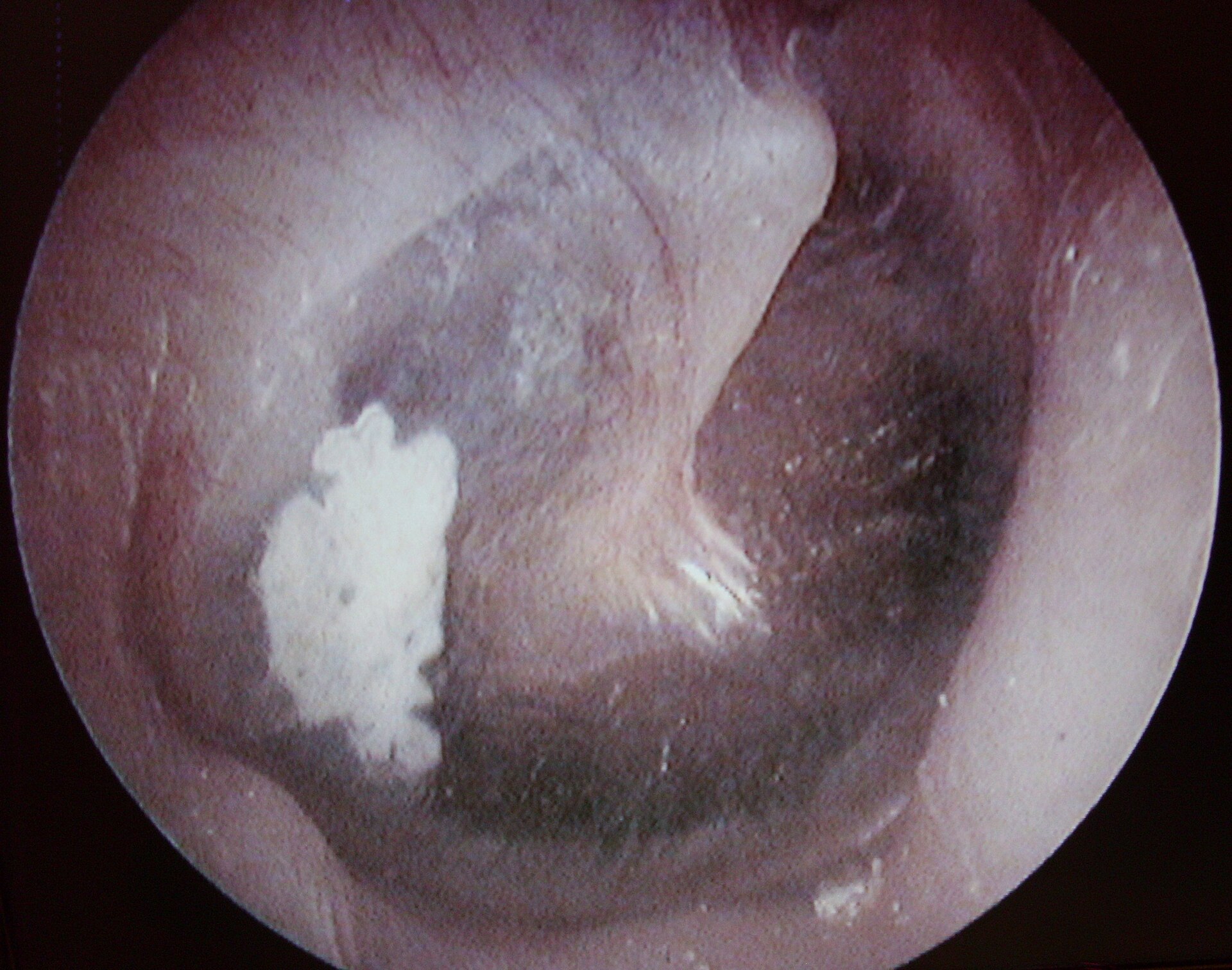 Imagem de referência de timpanoesclerose, descrito nos dados abertos como condição causada pela hialinização e subsequente calcificação do tecido conjuntivo subepitelial da membrana timpânica e do ouvido médio