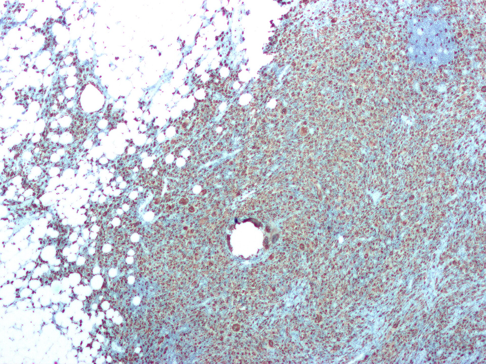 Imagem de referência de pielonefrite, descrito nos dados abertos como inflamação do rim, geralmente causada por uma infeção bacteriana