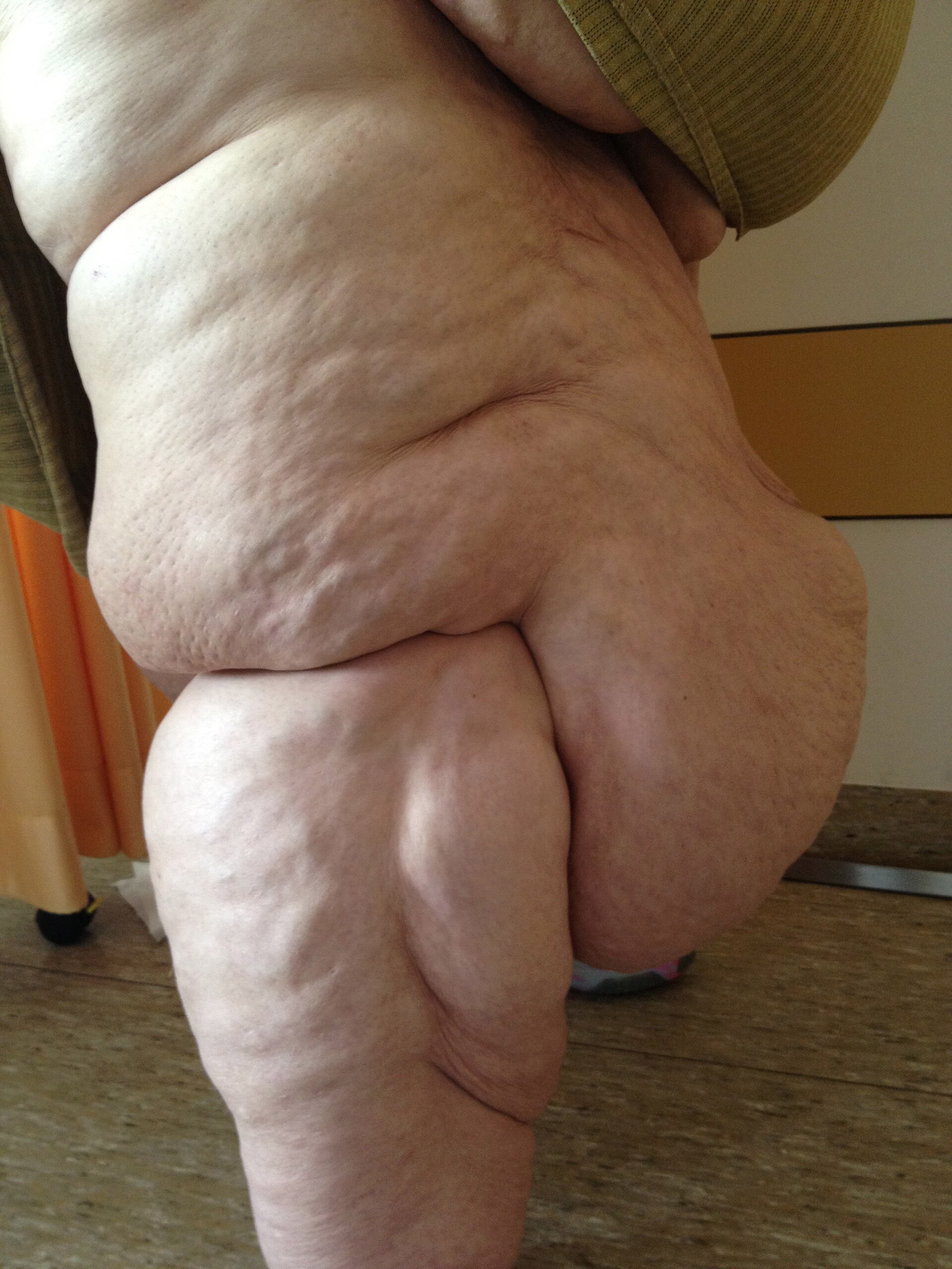 Imagem de referência de Lipedema, descrito nos dados abertos como doença crônica do tecido gorduroso