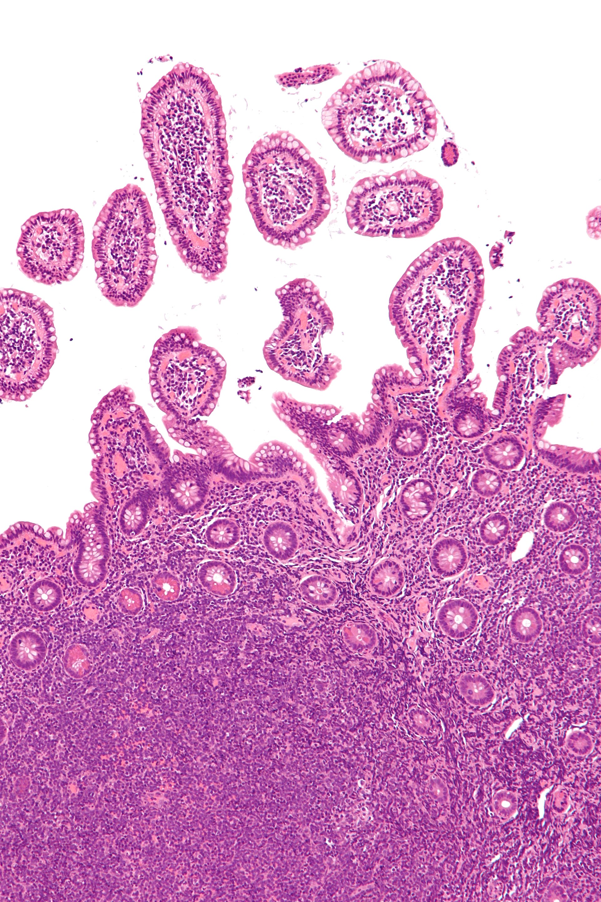 Imagem de referência de linfoma não Hodgkin, descrito nos dados abertos como tumor dos tecidos hematopoético e linfoide