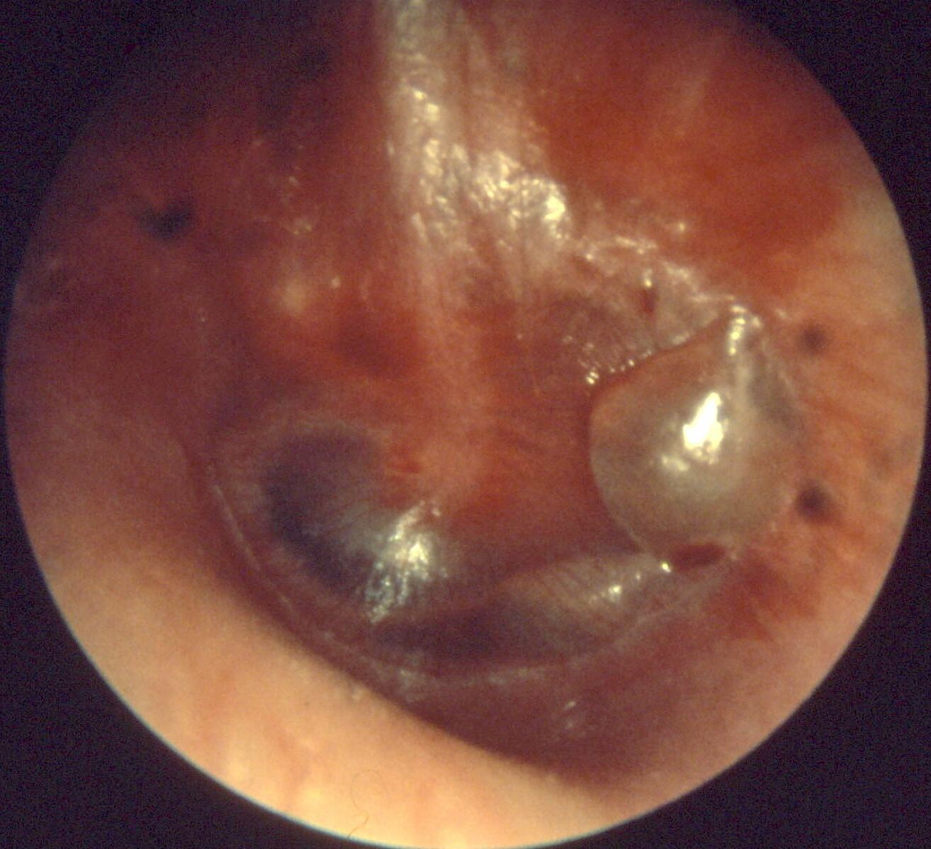 Imagem de referência de otite média, descrito nos dados abertos como processo de inflamação da orelha média e de acúmulo de fluído na orelha média