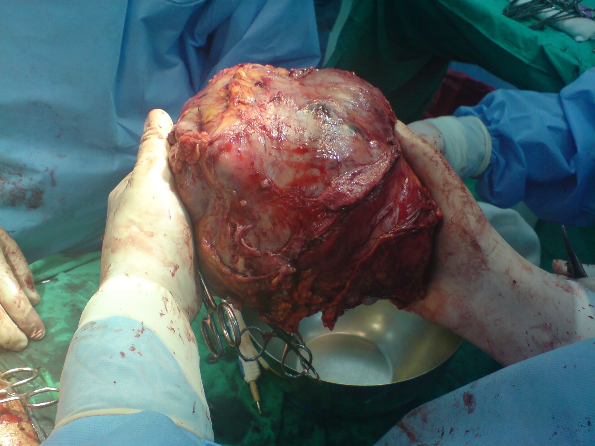 Imagem de referência de cancro do fígado, descrito nos dados abertos como tumor maligno que surge no fígado tanto por metástase ou pelas próprias células hepáticas