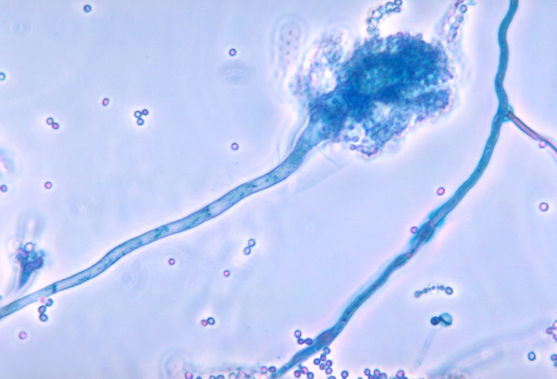 Imagem de referência de Aspergilose broncopulmonar alérgica, descrito nos dados abertos como condição médica
