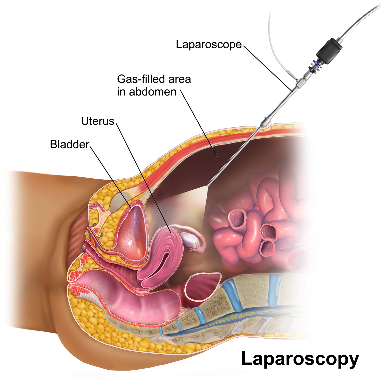 Imagem de referência de laparoscopia, descrito nos dados abertos como procedimento cirúrgico