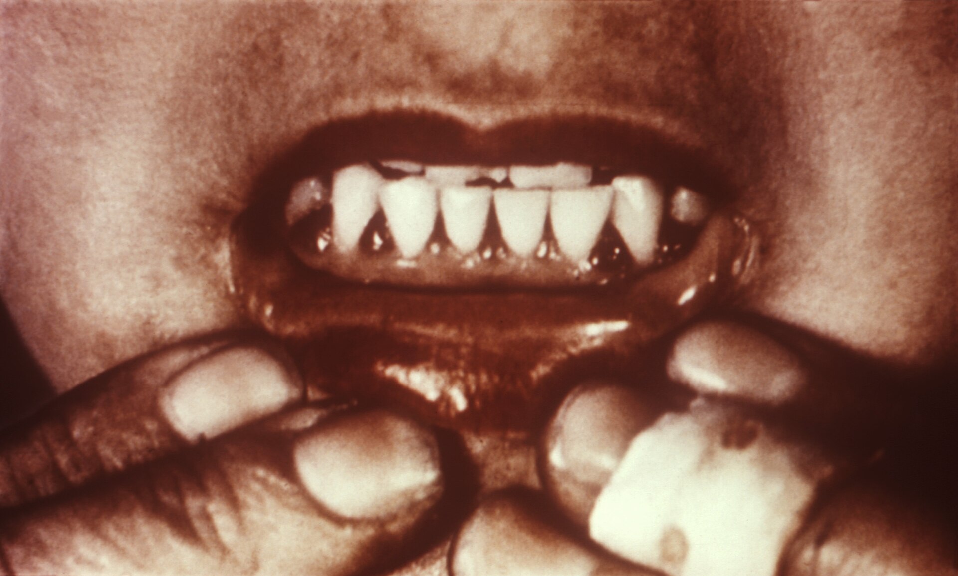 Imagem de referência de doença periodontal, descrito nos dados abertos como doença causada por bactérias que geram inflamações nos tecidos de suporte dos dentes