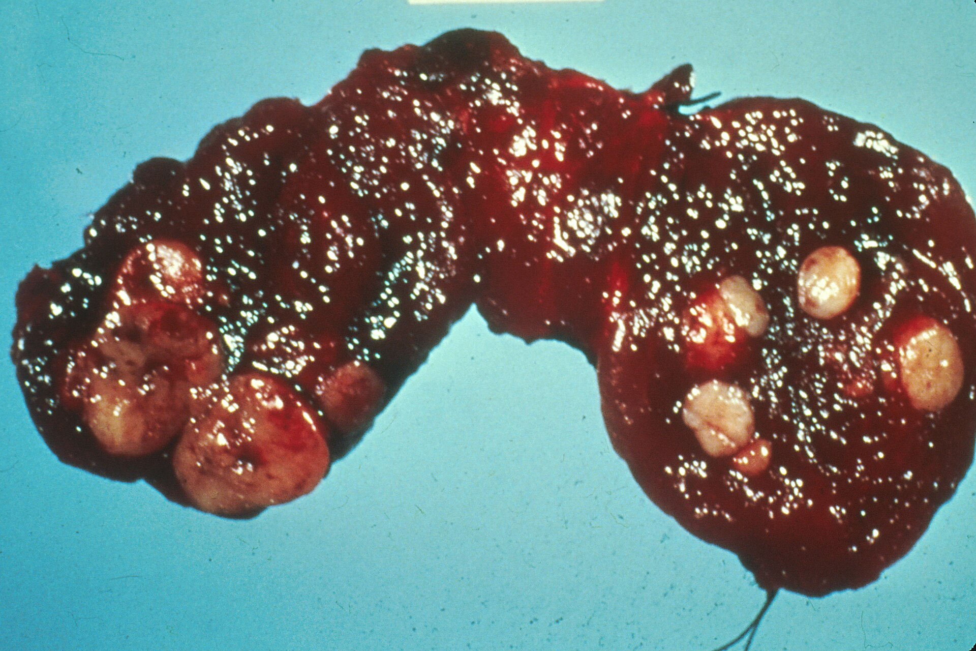 Imagem de referência de tumor da tiroide, descrito nos dados abertos como tumor maligno que surge na tiróide