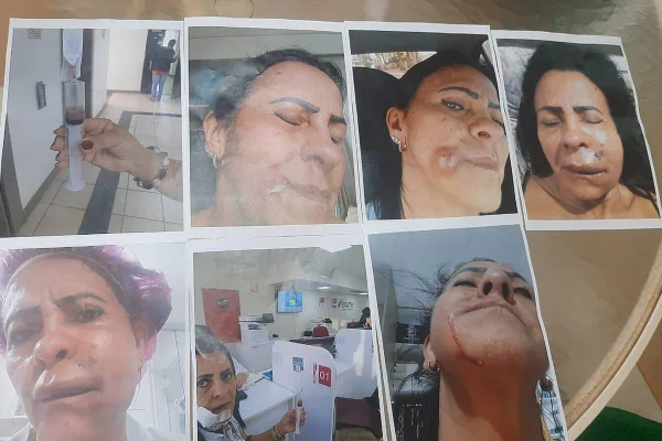 PMMA: dentista que deformou mulher é condenado, mas dá calote de R$ 97 mil - destaque galeria