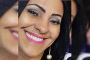 PMMA: dentista que deformou mulher é condenado, mas dá calote de R$ 97 mil